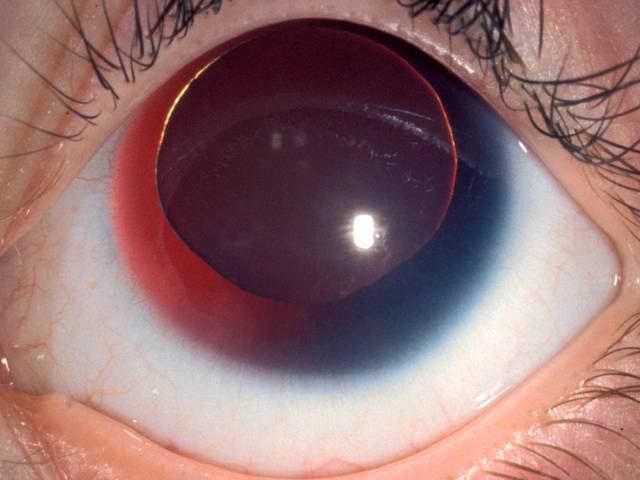 Гифема глаза: причины заболевания, фото и лечение