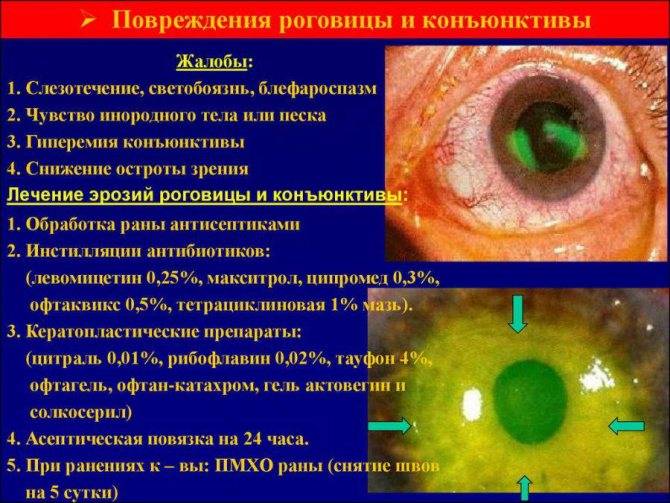 Повреждение роговицы глаза: лечение и последствия oculistic.ru
повреждение роговицы глаза: лечение и последствия