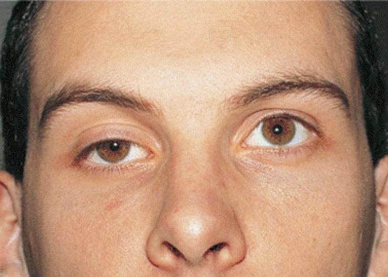 Возможные причины, ассиметричного размера глаз
