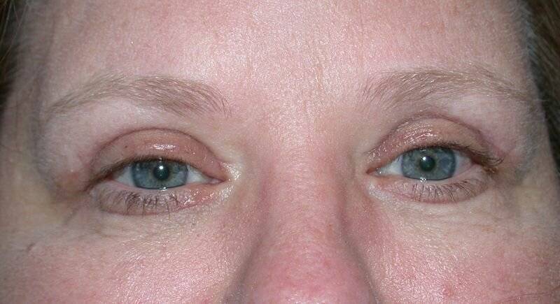 Дергается глаз, нижнее веко: причины и лечение, что делать при тике левого или правого глаза (препараты, физеотерапия, народные средства), возможные осложнения и прогноз