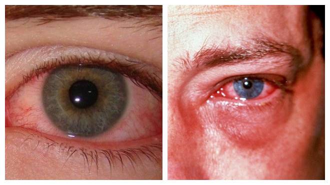 Ожог глаз от сварки: чем лечить?