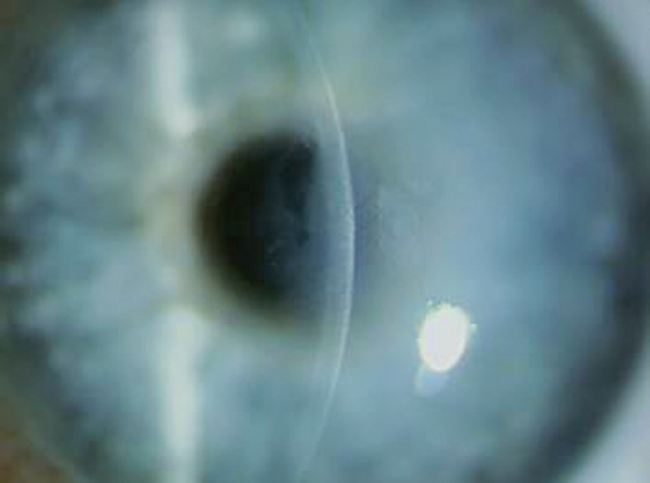 Эндотелиальная дистрофия роговицы глаза - "здоровое око"