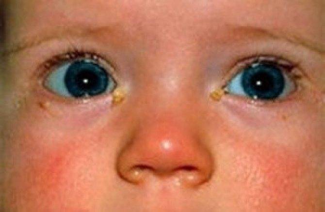 Воспаление глаз у ребенка