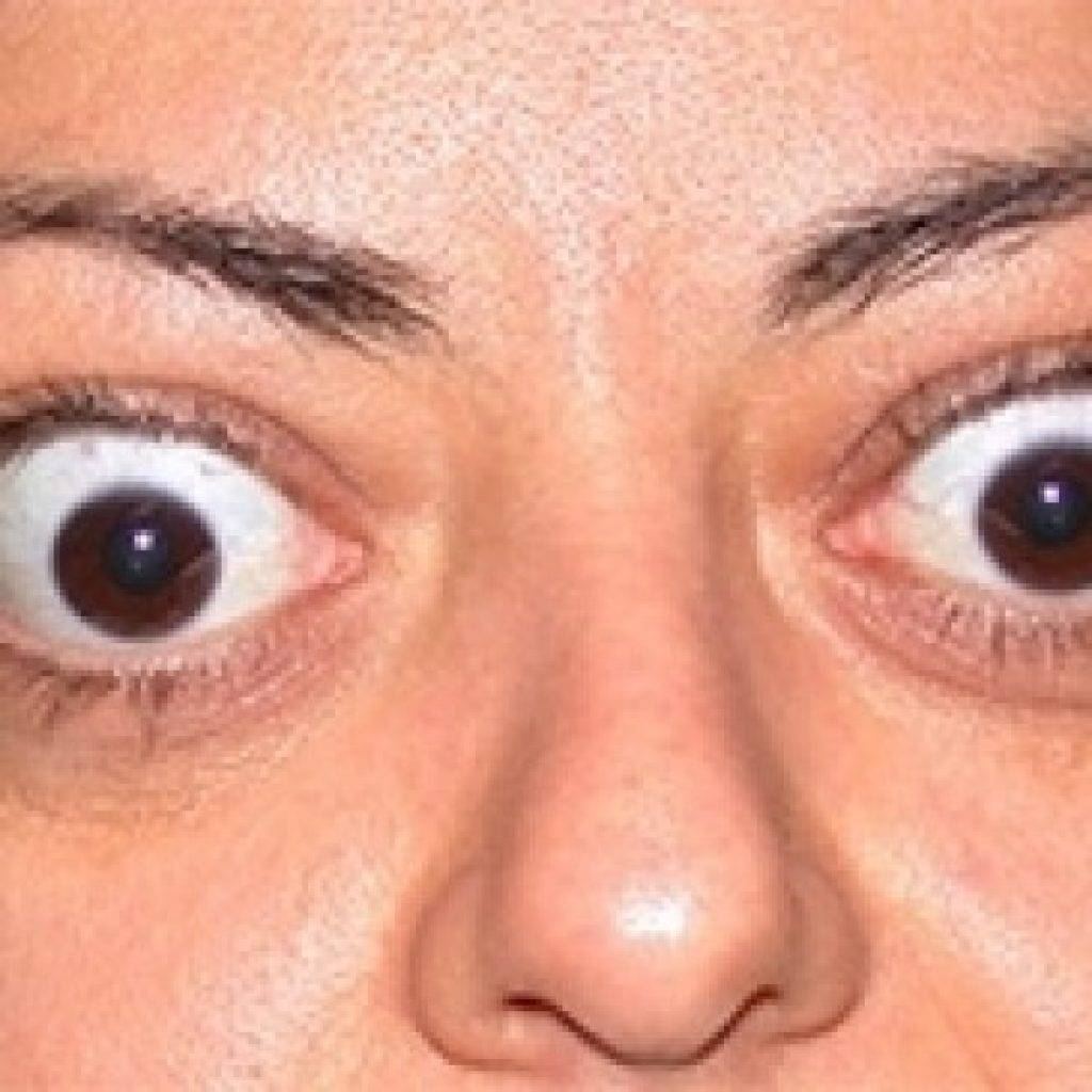 Выпученные глаза у человека: причины болезни и лечение oculistic.ru
выпученные глаза у человека: причины болезни и лечение