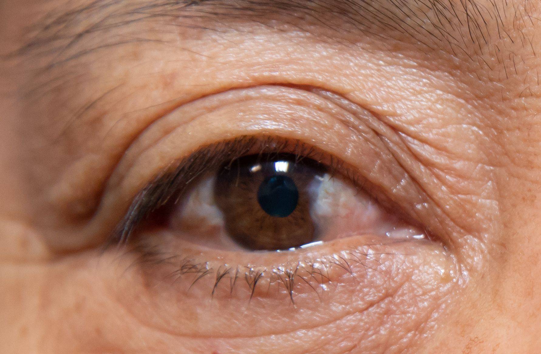 Птеригиум глаза: причины, симптомы и лечение