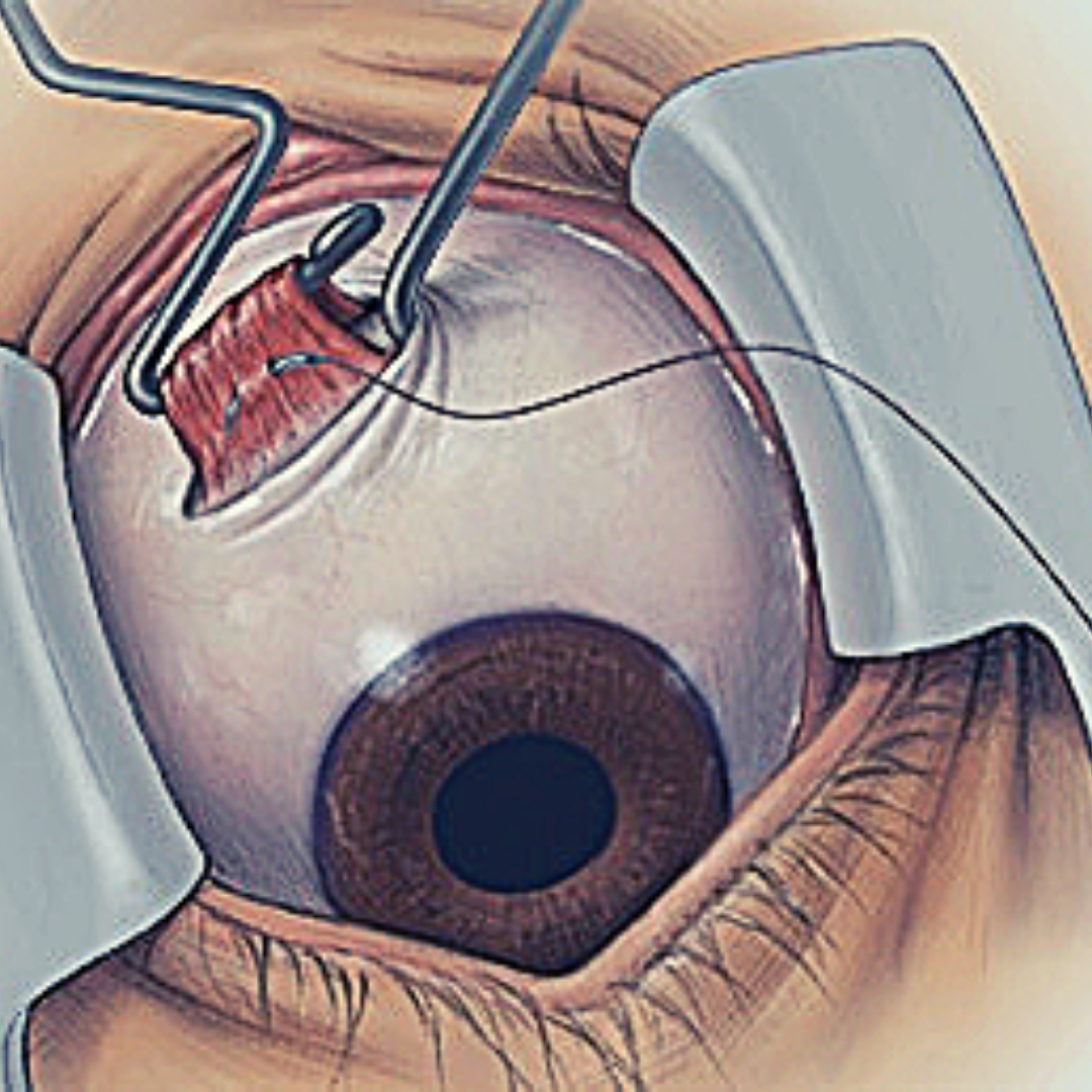 Укрепление склеры глаза | лечение глаз