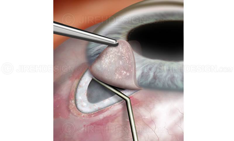 Хирургическое лечение глаукомы: 5 популярных операций