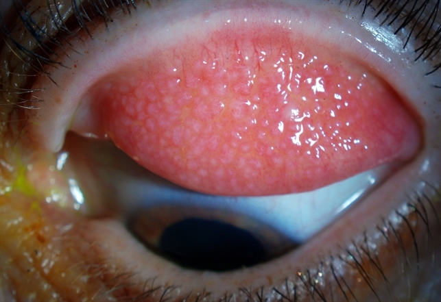 Трахома глаз — заболевание опасное, но поддающееся лечению!