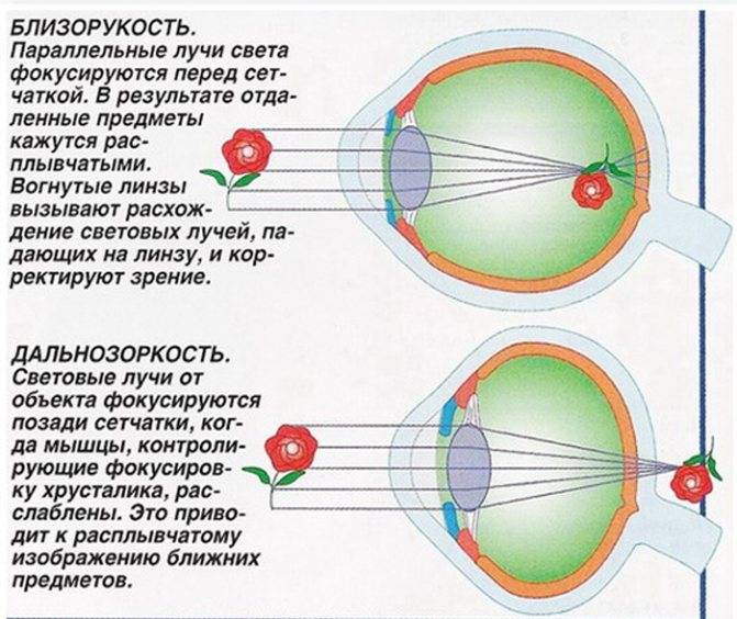 Что такое гиперметропия (дальнозоркость) слабой степени: лечение обоих глаз