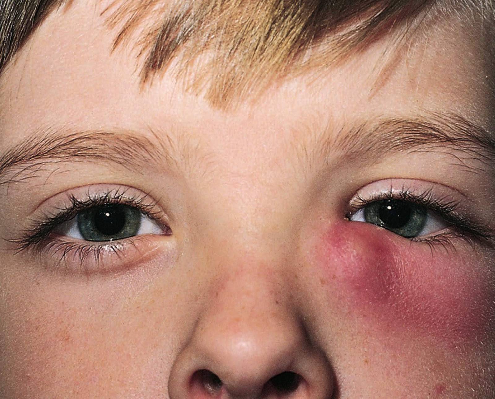 Глаза красные и гноятся у взрослого: первые симптомы