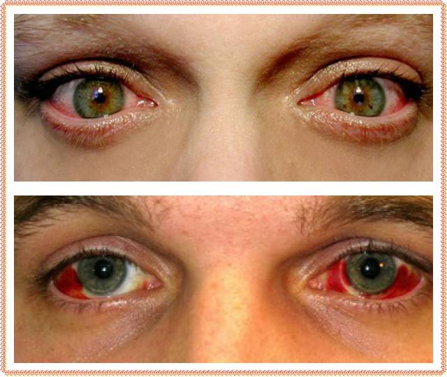 Как лечить кровоизлияние в глазу