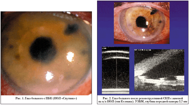 Кератопластика (операция по пересадке роговицы глаза) - подготовка, ход, реабилитация