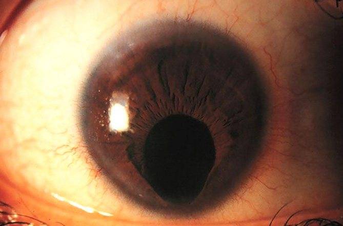 Колобома глаза (века, хрусталика, диска зрительного нерва, сосудистой оболочки, хориодеи, сетчатки): причины, симптомы, лечение, врожденная и приобретенная формы