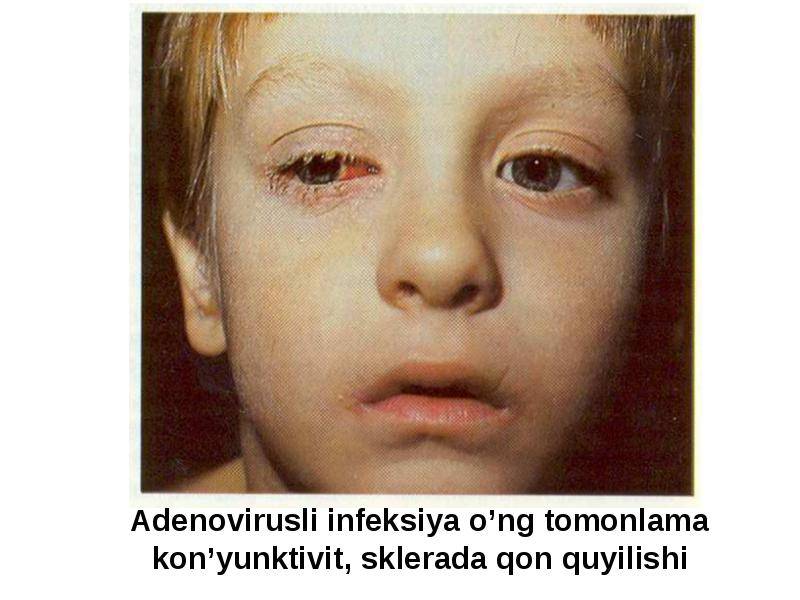 Аденовирусный конъюнктивит – симптомы и лечение у детей и взрослых