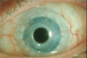 Эвисцерация глазного яблока: ход процедуры, плюсы и минусы