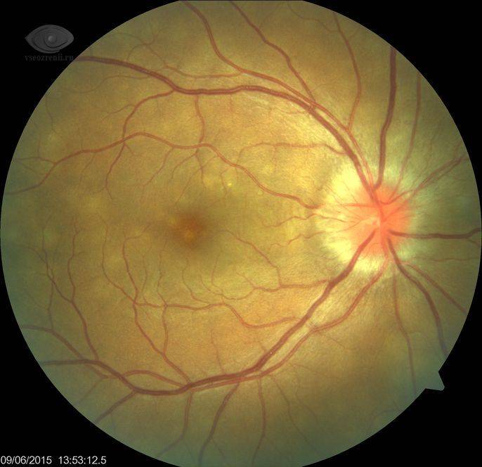 Колобома глаза - симптомы и лечение
