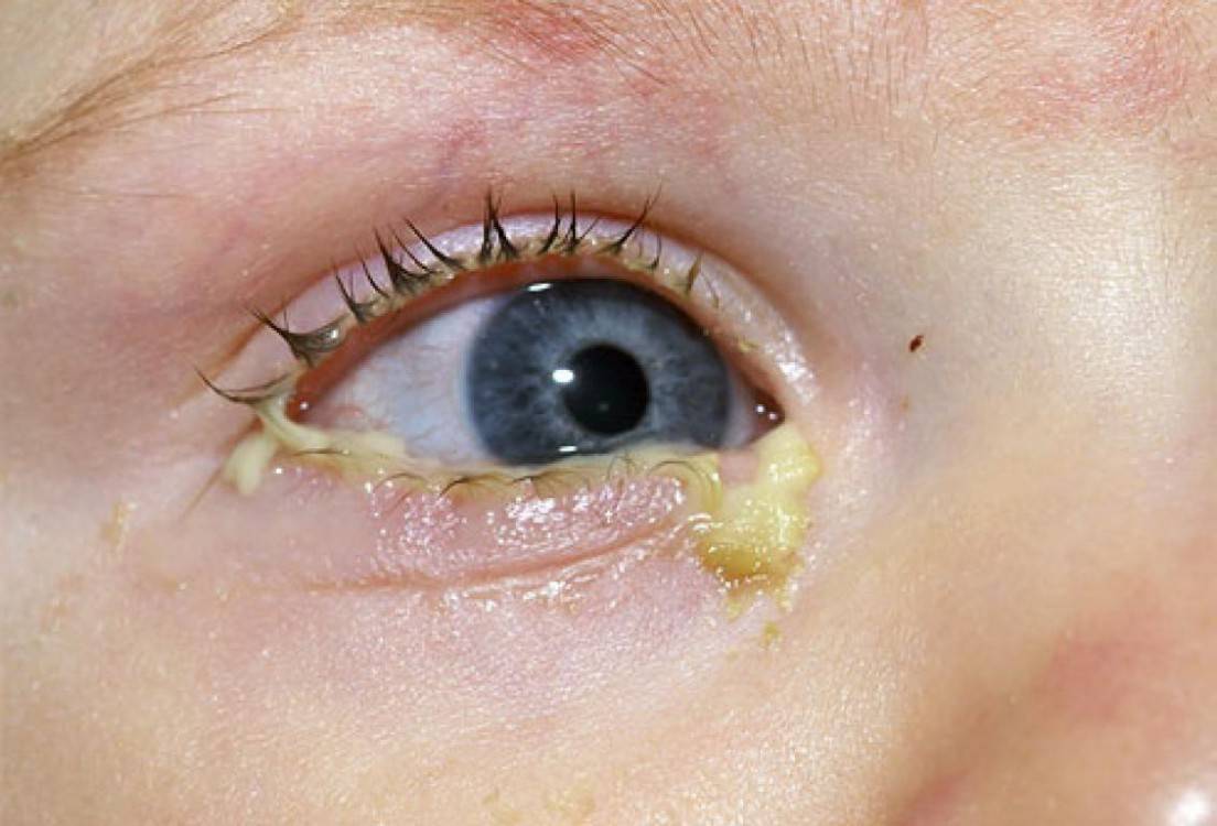 Чем лечить, если гноятся глаза у ребенка?