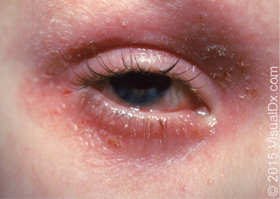 Сухость и шелушение кожи под глазами. причины и способы лечения кожи век