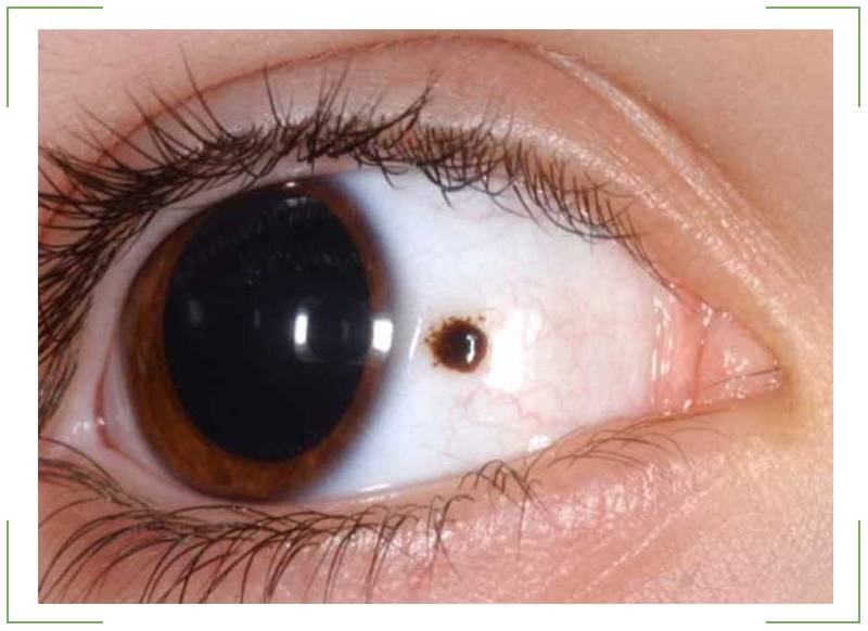 Опухоль глаза — симптомы, причины, лечение