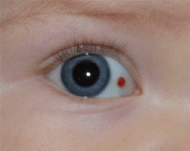 Пятна на глазном яблоке (родимые, серые, коричневые, темные, черные точки), на белке, сетчатке, зрачке: причины, фото, симптомы, лечение