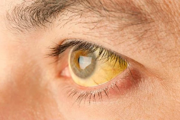 Почему появляются желтые круги под глазами: причины и лечение?