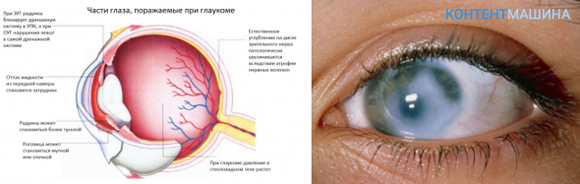 Эффективность операции при глаукоме