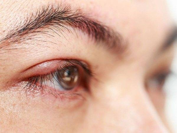 Халязион на глазу верхнего и нижнего века лечение: что такое халязион