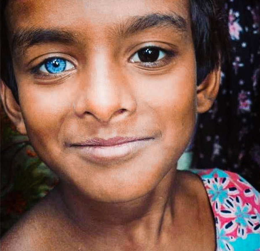 Синдром Ваарденбурга Эстетика. Тайцы раса. Необычный цвет глаз. Необычные глаза у людей.