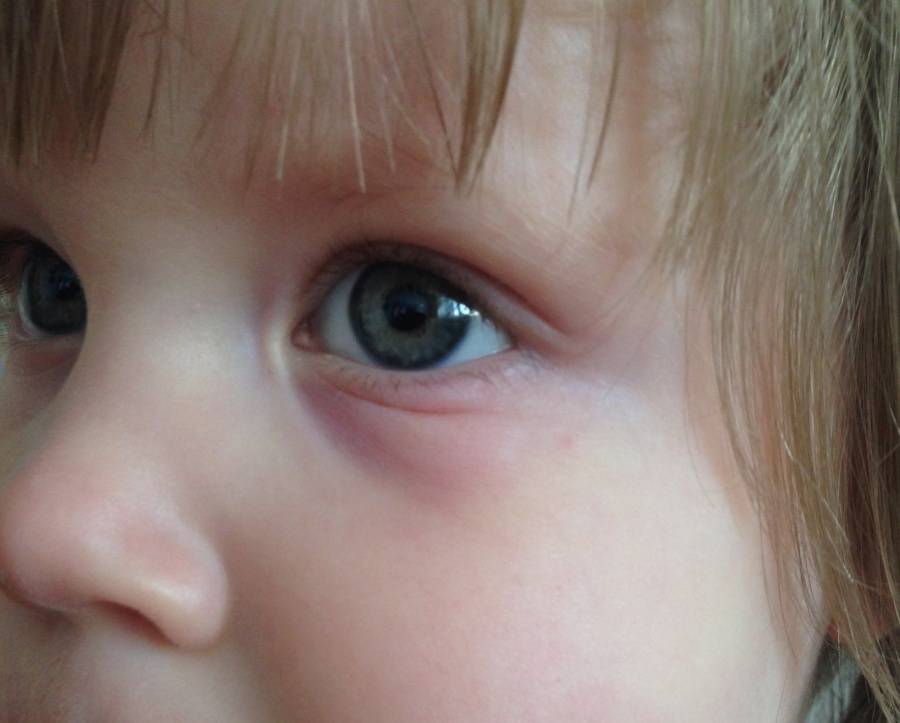 У ребенка мешки под глазами: причины и что делать