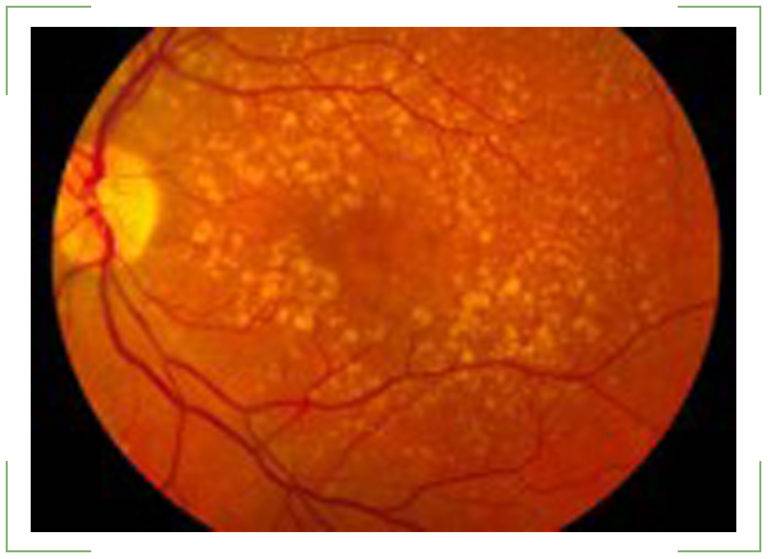 Гипертонический ангиосклероз сетчатки и сосудов глаза: лечение и профилактика