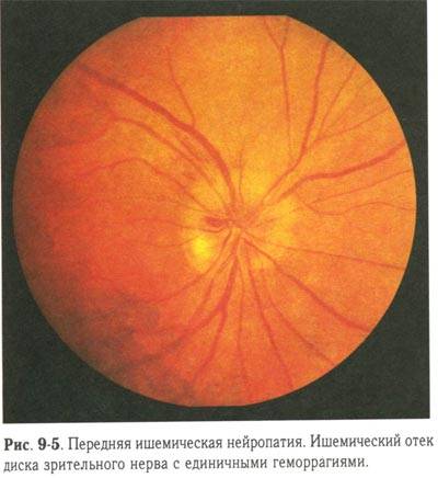 Как выглядит колобома глаза – виды, причины и лечение дефекта