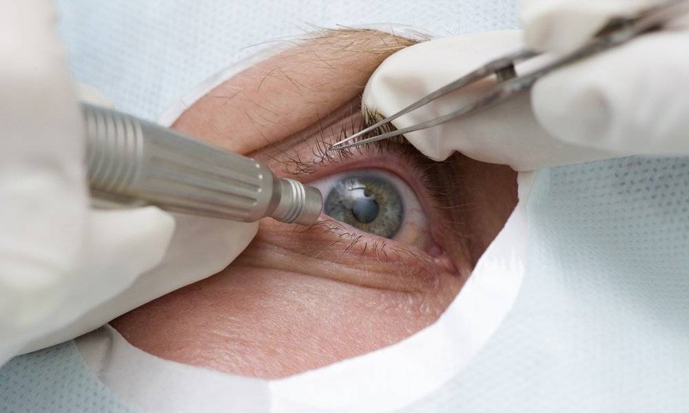 Уколы в глаза: для сетчатки, интравитреальная инъекция что это, как делают под яблоко, виды, больно или нет