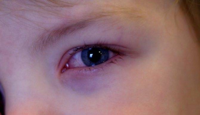 Маме на заметку: что делать, если у ребёнка красные глаза и чешутся?