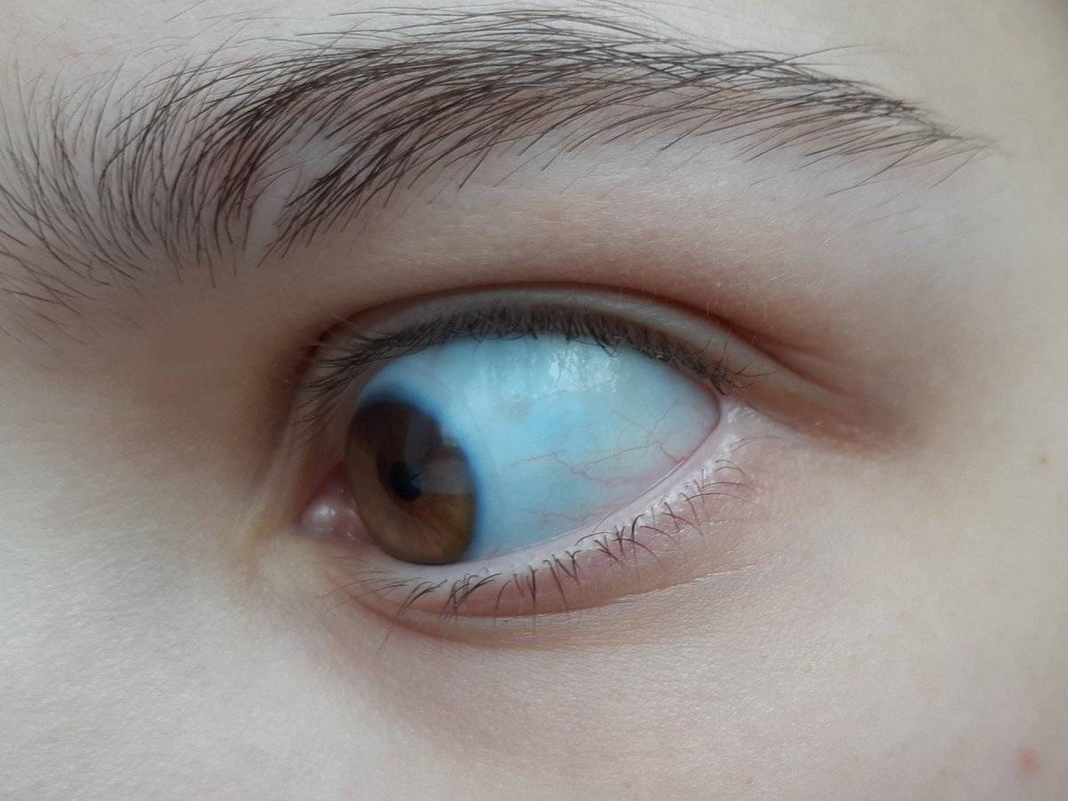 Что означают глазные белки с синим оттенком. почему у ребенка серые белки глаз