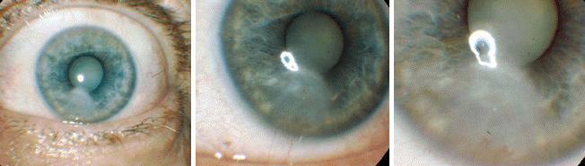 Операция на глаза – катаракта: удаление старческой перезрелой