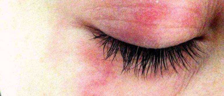 Заболевания глаз. часть 1. кожа вокруг глаз и веки, заболевания конъюнктивы, слезных органов и наружной оболочки глаза