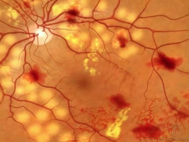 Как определить и лечить диабетическую ретинопатию глаз – опасное осложнение диабета