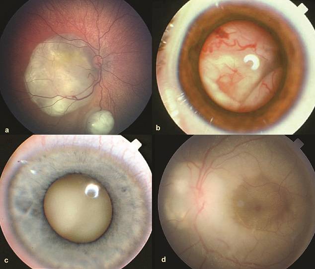 Виды и стадии заболевания ретинобластомой у детей