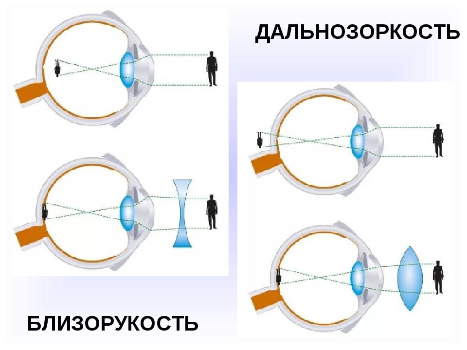 Что, по мнению врачей, лучше: контактные линзы или очки? все за и против обоих видов оптики