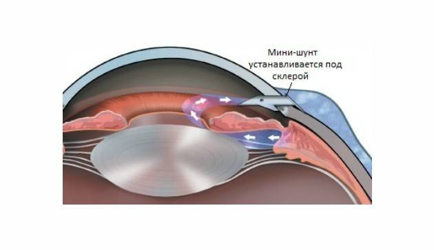Операция при глаукоме: виды лечения, послеоперационный период и последствия
