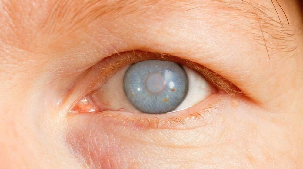 Куриная слепота у человека - как возникает, проявляется и развивается расстройство зрения