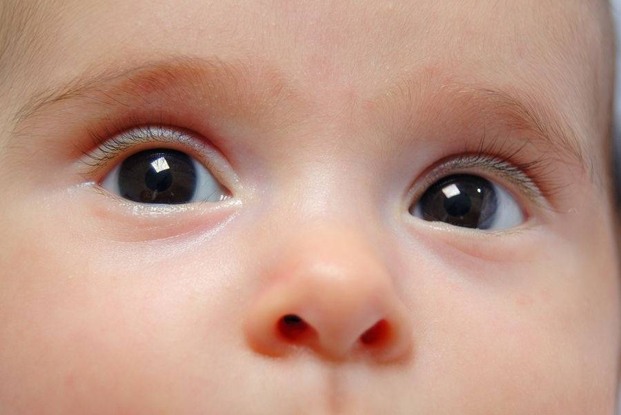 Желтые белки глаз у новорожденного – норма или отклонение?