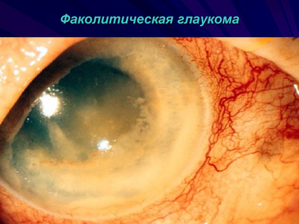 Глаукома: причины, симптомы, лечение – напоправку