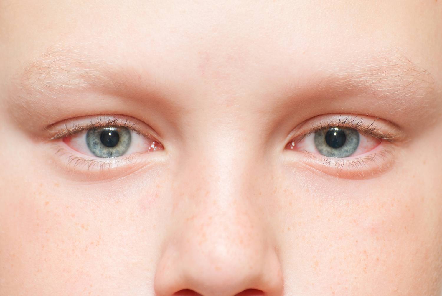 Красные глаза у ребенка: причины, симптоматика и методы лечения - "здоровое око"