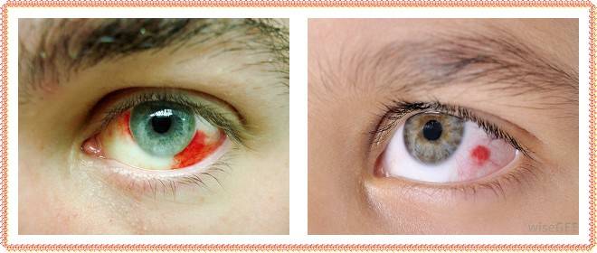 Гифема (кровоизлияние в переднюю камеру глаза): что это такое, симптомы, причины, лечение (капли и прочие средства), прогноз и другие аспекты