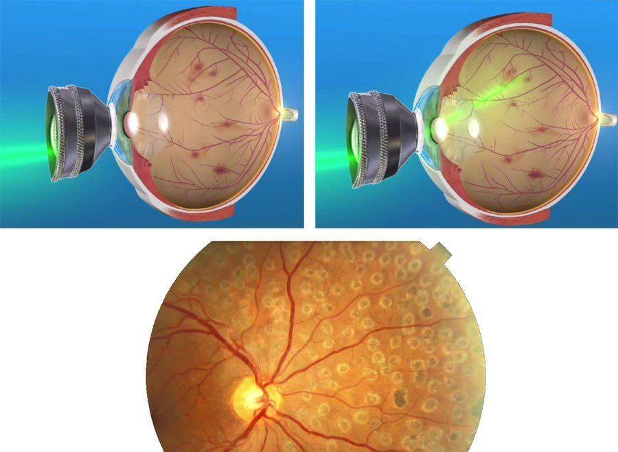 Лазерная коагуляция сетчатки глаза - послеоперационный период