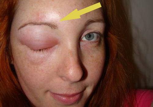 Как снять аллергический отек с глаз быстро?