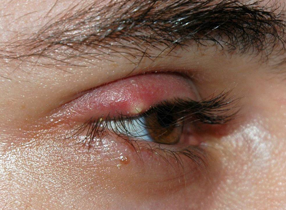 Ячмень на глазу – причины, симптомы и лечение болезни (фото)