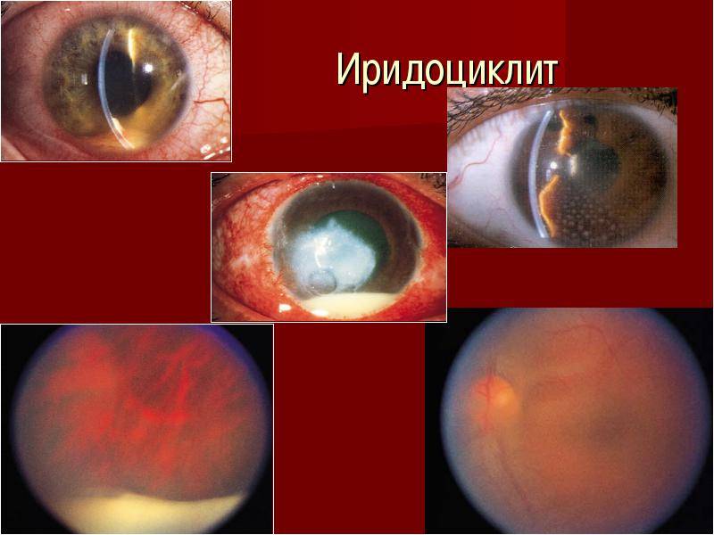 Иридоциклит глаз (передний увеит) простыми словами: лечение, симптомы, профилактика