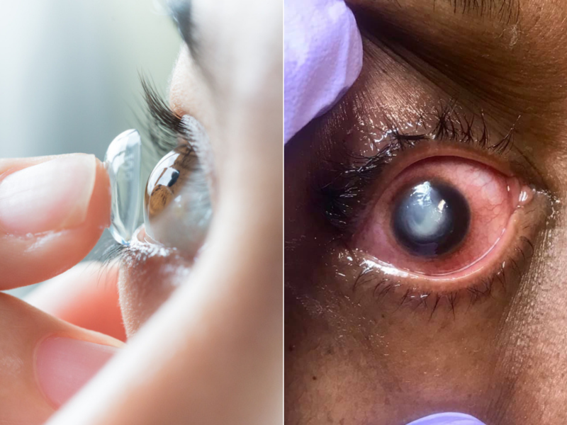 Сухость глаз при ношении контактных линз - причины и симптомы